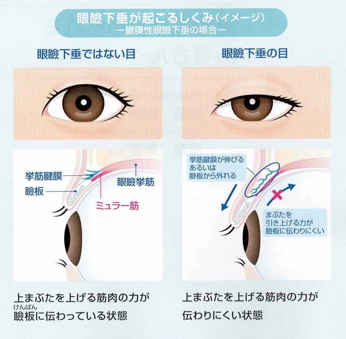 眼瞼下垂が起こるしくみのイメージ