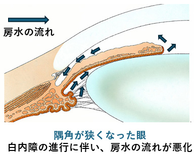 写真:狭隅角とは