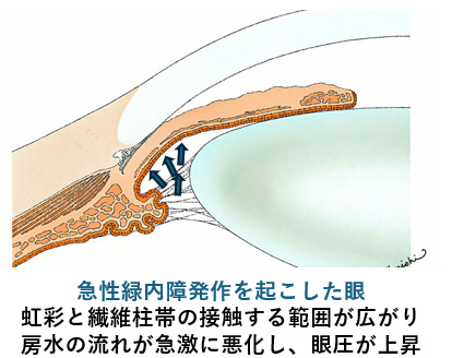 写真:急性緑内障発作について