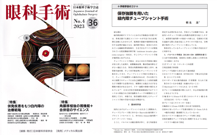 日本眼科手術学会雑誌「眼科手術」Vol.36 No.4 保存強膜を用いた緑内障チューブシャント手術