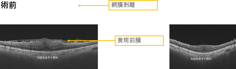 黄斑前膜