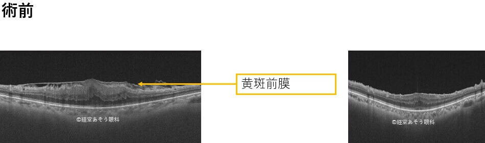 黄斑前膜