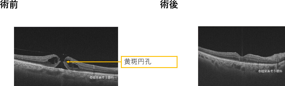 黄斑円孔