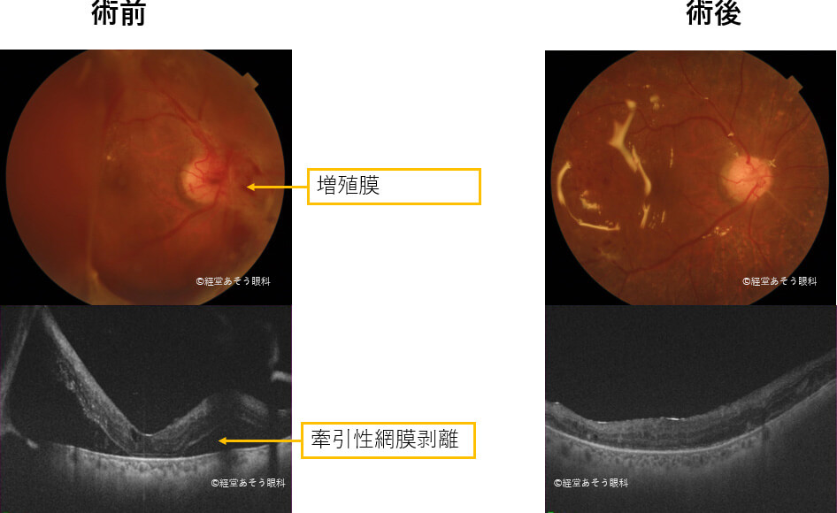 牽引性網膜剝離・硝子体出血を合併した増殖性糖尿病網膜症