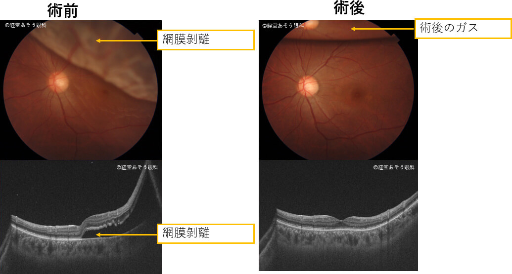裂孔原性網膜剥離