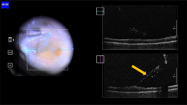 黄斑前膜の手術映像